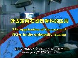 Application of external fixator in trauma orthopedics