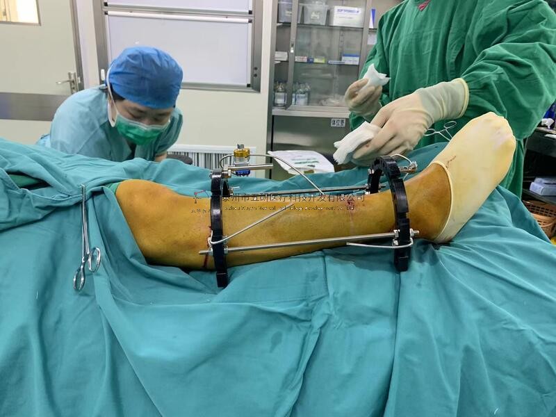 【望京医院】不开刀治骨折——右胫腓骨骨折病例分享