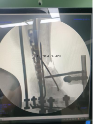 【最新病例】三臂十一轴机器人辅助器牵引——骨折外固定术骨折案例分享