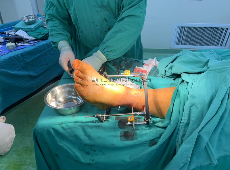 不开刀治骨折——CO接骨架典型病例分享